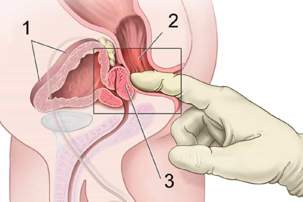 Har du symptomer på eksempelvis kræft i prostata eller blærehalskirtlen, kan din læge nemt foretage en undersøgelse ved at føre en finger et par centimeter op i endetarmen. 1: Blære. 2: Endetarm. 3: Prostata/Blærehalskirtel.