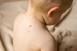 Ved du, hvad du skal gøre, hvis dit barn får skoldkopper? Hvis ikke så læs med her, hvor du får en masse gode råd til at hjælpe dit barn.